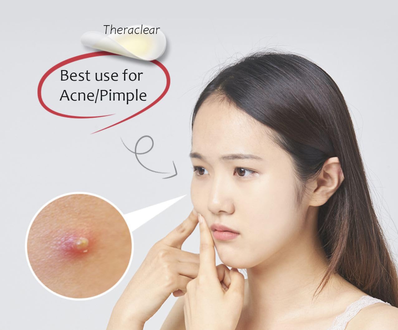 TheraClear Korean Hydrocolloid Acne Spot Patches 10mm & 12mm 51 count - Made in Korea]