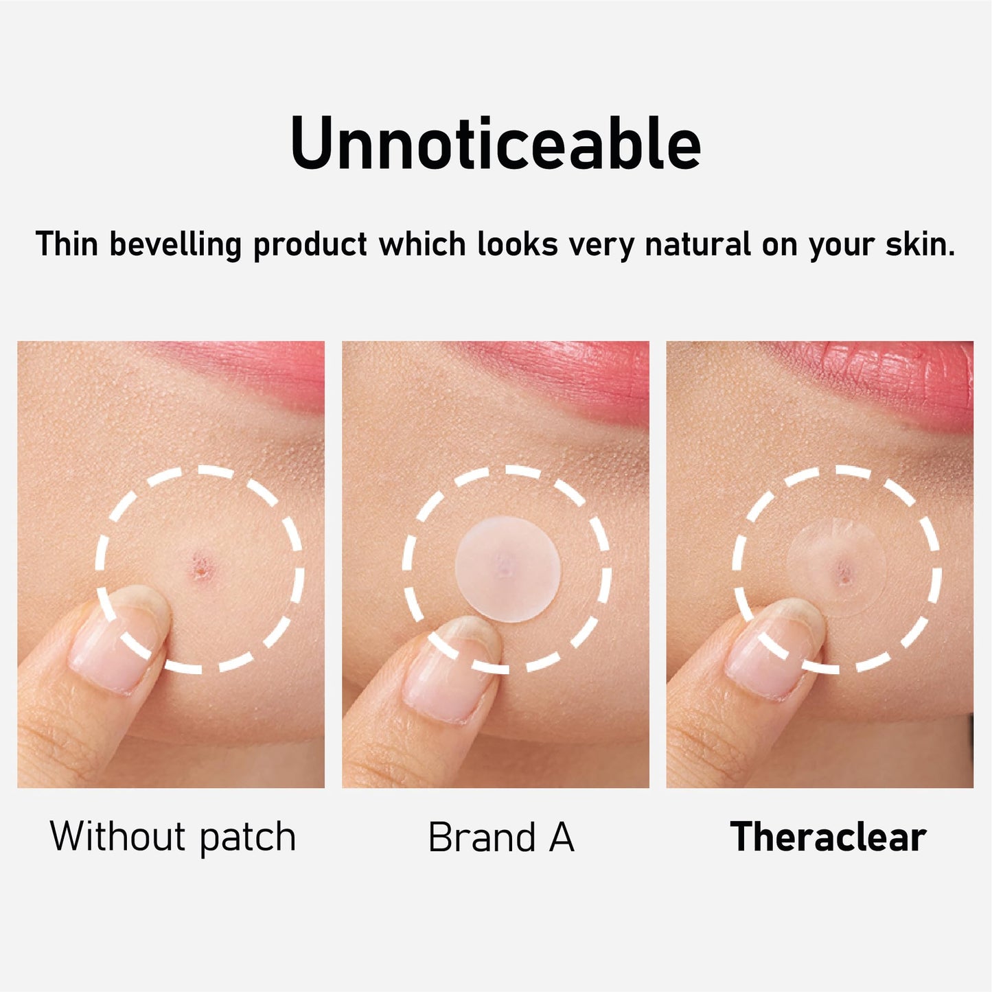 TheraClear Korean Hydrocolloid Acne Spot Patches 10mm & 12mm 51 count - Made in Korea]